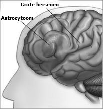astrocytoom hersentumor
