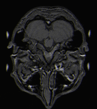 hersen MRI T1 scan