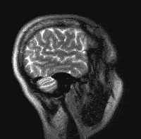 hersentumor MRI laagjes zijkant