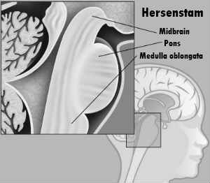 hersenstam pons glioom hersentumor